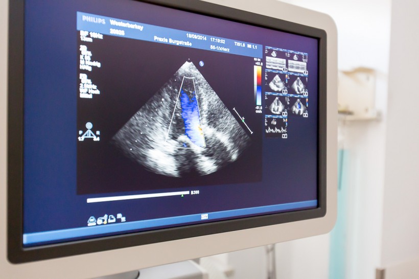 Transesophageal echocardiography (TEE)